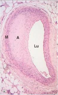 The accompanying photomicrograph shows narrowing of an artery by an atheroma (A) .Which one of the following would be the likely clinical symptom(s) if the artery in question were located in the lower extremities?   A) Muscle cramping B) Claudication C) Hemiplegia (paralysis of one leg)  D) Spasticity of the muscle E) Tingling in the skin