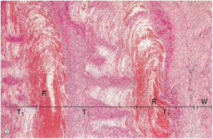 The accompanying photomicrograph shows alternating layers of a thrombus.This layering effect is known by which one of the following terms?   A) Alternating current B) Bilayer cementing C) Lines of Zahn D) Zebra stripes