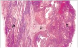 The accompanying low power photomicrograph of the left ventricle shows a thrombus (T) in the heart of a 66 year old man who died of a heart attack.Which one of the following factors most likely explains the underlying pathophysiologic reason for a thrombus to occur in this area?   A) Endocardial (endothelial) damage B) Hypercoagulability C) Hypertension D) Inflammation E) Vasospasm