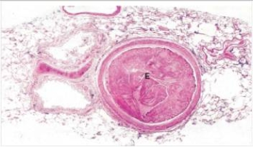 This low power photomicrograph of the lung shows a thromboembolism within a pulmonary artery.What is the most likely source for this thrombus?   A) Deep leg veins B) Left atrium C) Left ventricle D) Likely formed in situ on top of an atherosclerotic plaque E) Right atrium  F) Right ventricle G) Vena cava