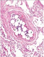 This medium power photomicrograph of a small artery likely depicts the result of which one of the following pathophysiologic events?   A) Atherosclerosis B) Fracture of a long bone C) Organisation D) Recanalisation E) Therapeutic embolisation  F) Thromboembolism