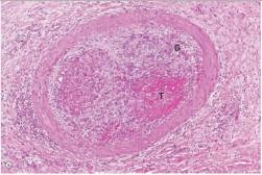 This medium power photomicrograph of a small artery depicts the result of which one of the following pathophysiologic events?   A) Atherosclerosis B) Fracture of a long bone C) Organisation D) Recanalisation E) Therapeutic embolisation  F) Thromboembolism