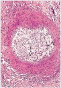 This medium power photomicrograph of a small artery depicts the results of which one of the following pathophysiologic events?   A) Atherosclerosis B) Fracture of a long bone C) Organisation D) Recanalisation E) Therapeutic embolisation  F) Thromboembolism