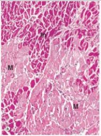 In the accompanying high power photomicrograph of infarcted myocardium tissue,which one of the following estimates of the age of the infarct is most likely correct?   A) 1-2 hours B) 4-24 hours C) 2-3 days D) 10 days E) 2 weeks  F) 1 year