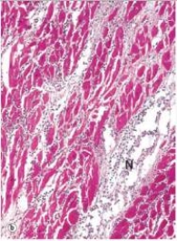 In the accompanying high power photomicrograph of infarcted myocardium tissue,which one of the following estimates of the age of the infarct is most likely correct?   A) 1-2 hours B) 4-24 hours C) 2-3 days D) 10 days E) 2 weeks  F) 1 year