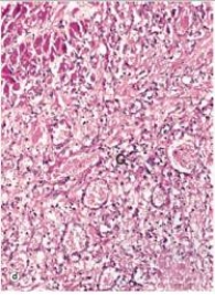 In the accompanying high power photomicrograph of infarcted myocardium tissue,which one of the following estimates of the age of the infarct is most likely correct?   A) 1-2 hours B) 4-24 hours C) 2-3 days D) 10 days E) 2 weeks  F) 1 year