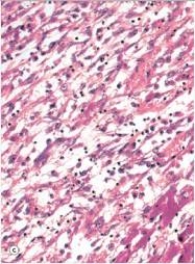 In the accompanying high power photomicrograph of infarcted myocardium tissue,which one of the following is a likely complication during this stage of myocardial infarction?   A) Granuloma formation B) Haemopericardium C) Hypertrophic scar D) Neoplastic transformation