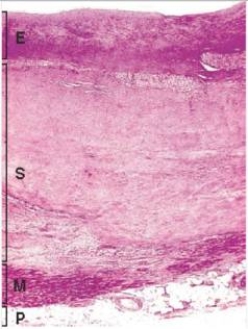 In the accompanying high power photomicrograph of infarcted myocardium tissue,which one of the following estimates of the age of the infarct is most likely correct?   A) 1-2 hours B) 4-24 hours C) 2-3 days D) 10 days E) 2 weeks  F) 1 year