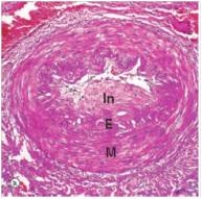 In this medium power photomicrograph of a medium artery in a patient with systemic hypertension,the area of the image labelled  In  depicts which one of the following pathologic processes?   A) Intimal necrosis B) Intimal proliferation C) Thrombosis D) Organisation E) Recanalisation
