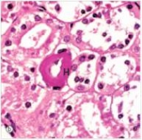 In this high power photomicrograph of a renal arteriole from a diabetic patient,the area of the image labelled  H  depicts which one of the following pathologic processes?   A) Atrophy B) Hyaline change C) Infarction of the vessel wall D) Thrombosis