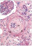 This high power photomicrograph of a medium sized artery in a patient with severe hypertension depicts a serious condition that is known by which one of the following words or phrases?   A) Glomerulosclerosis B) Hyaline arteriolosclerosis C) Intimal proliferation D) Malignant hypertension