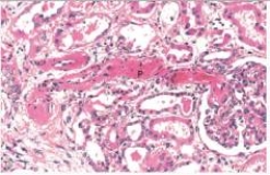 This high power photomicrograph of a renal arteriole in a patient with severe hypertension depicts a serious condition that is known by which one of the following words or phrases?   A) Atrophy B) Fibrinoid necrosis C) Hyaline arteriolosclerosis D) Renal infarction