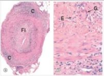 A 54 year old man presented to his primary care physician complaining of headache.A tortuous artery,which was indurated and tender to touch,was noted on his forehead.A representative section of a biopsy of this artery is shown in the accompanying photomicrograph,in low and high power.Which one of the following is the best diagnosis?   A) Atherosclerosis B) Giant cell arteritis C) Polyarteritis nodosa D) Thromboembolism E) Tuberculosis