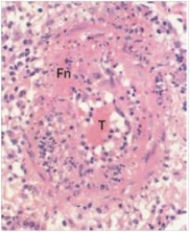 A 38 year old female was seen for  fever of unknown origin  (FUO) .In addition to fever,she was experiencing abdominal pain.Finally,it was decided that an appendicectomy was required,as her pain seemed to favour the right lower quadrant.The appendix was essentially normal microscopically,but a small artery in the fat surrounding the appendix demonstrated the findings seen in the accompanying photomicrograph.Which one of the following is the best diagnosis?   A) Acute appendicitis B) Acute inflammation C) Chronic inflammation D) Polyarteritis nodosa