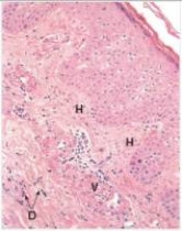A 16 year old female was given penicillin for an apparent  Strep throat .She soon developed a reddish-appearing skin rash,which was firm when palpated.A biopsy was performed.A representative section of the biopsy is shown in the accompanying photomicrograph.Which one of the following is the best diagnosis?   A) Angiosarcoma B) Giant cell arteritis C) Glomus tumour D) Haemangioma E) Kaposi's sarcoma  F) Leukocytoclastic vasculitis (microscopic polyarteritis)  G) Polyarteritis nodosa