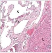 A 24 year old woman,who was otherwise in excellent health,presented at the Emergency Department complaining of abdominal pain.Her past medical history was notable only for oral contraceptives.A peritoneal tap disclosed gross blood so emergency open laparotomy (abdominal exploration) was performed.A bleeding mass in the liver (L) was found,resected,and good haemostasis was obtained.The patient recovered without further incident.A representative section of the resected mass is shown in the accompanying photomicrograph.Which one of the following is the best diagnosis?   A) Angiosarcoma B) Giant cell arteritis C) Glomus tumour D) Haemangioma E) Kaposi's sarcoma  F) Leukocytoclastic vasculitis (microscopic polyarteritis)  G) Polyarteritis nodosa