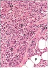 A 30 year old male homosexual,who was HIV-positive,presented to his primary care physician complaining of a rash on his arm.He had not been taking his anti-retroviral drugs,due to the side effects.Numerous,slightly raised,purple lesions were noted on the patient's forearm by the examining physician.A biopsy of one of the nodules was performed.A representative section of the biopsy is shown in the accompanying photomicrograph.Which one of the following is the most likely diagnosis?   A) Angiosarcoma B) Giant cell arteritis C) Glomus tumour D) Haemangioma E) Kaposi's sarcoma  F) Leukocytoclastic vasculitis (microscopic polyarteritis)  G) Polyarteritis nodosa