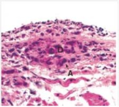 A 15 year old girl developed fever,aching joints,and a heart murmur.Her past medical history was negative,except for a  Strep throat  approximately 6 weeks prior,for which she did not seek treatment.An endomyocardial biopsy was performed,via the external jugular vein,a representative section of which is shown in the accompanying photomicrograph.Which one of the following best describes the pathology seen in the biopsy?   A) Acute inflammation B) Aschoff nodule C) Chronic inflammation D) Rheumatoid nodule E) Rheumatic fever