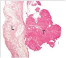 A 67 year old man,with a known history of inoperable pancreatic adenocarcinoma,suddenly developed symptoms of a massive stroke,losing the ability to walk.He subsequently died from cerebral oedema,and the family requested an autopsy.In the accompanying low power photomicrograph of a mitral valve leaflet (L) ,the thrombus (T) attached to the leaflet was probably caused by which one of the following pathophysiologic conditions?   A) Anaemia B) Biliary obstruction by tumour C) Diabetes mellitus D) Fever E) Hypercoagulable state A.Shock
