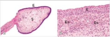 A 23 year old woman was seen by her primary care physician for a nasal obstruction.A polyp was seen and removed.A representative section is shown in the accompanying photomicrograph.From the histological appearance,which one of the following aetiological events is likely in this case?   A) Allergic sinusitis B) Bacterial sinusitis C) Neoplasm due to smoking D) Parasitic infection E) Viral sinusitis