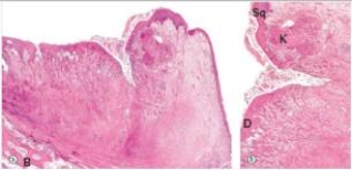 A 58-year-old white male with a 40 pack year smoking history presented to his local physician complaining of hoarseness for over one month.Laryngoscopy revealed an invasive tumour.A total laryngectomy was then performed,a representative section of which is shown in the accompanying photomicrograph.Which one of the following is the best diagnosis?   A) Adenocarcinoma B) Condyloma acuminatum C) Squamous cell carcinoma D) Squamous papilloma E) Transitional cell carcinoma