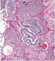 An otherwise well 68 year old woman presents at the Emergency Department with fever and shortness of breath.A chest-x-ray shows patchy lung infiltrates bilaterally.A pneumonologist is consulted,who then performs a bronchoscopic biopsy,a representative section of which is shown in the accompanying photomicrograph.Which one of the following is the best diagnosis?   A) Aspergillus pneumonia B) Bronchopneumonia C) CMV pneumonitis D) Lobar pneumonia E) Pneumocystis jirovecii pneumonia