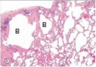 The accompanying photomicrograph shows a section of lung that had been resected from the right upper lobe of a 73 year old male who had smoked two packs of cigarettes a day since the age of 18.The inherent danger of bullae formation (B) in emphysema is the distinct possibility of which one of the following pathophysiologic events?   A) Aspergillus infection B) Heart failure C) Lung cancer D) Pneumothorax E) Tuberculosis