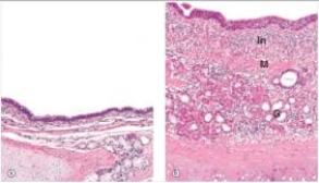 The accompanying photomicrograph compares normal bronchial mucosa (left) with abnormal mucosa (right) .The magnification is approximately the same.Which one of the following is the best diagnosis for the tissue depicted on the right?   A) Chronic bronchitis B) Emphysema C) Neoplasia (cancer)  D) Pneumonia E) Tuberculosis