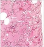 A 54 year old male with a long history of congestive heart failure due to coronary artery disease brought about by smoking presented at the Emergency Department in acute respiratory distress.He was coughing up copious amounts of pink,frothy fluid.Unfortunately,he died,and the family requested an autopsy.A representative section of his lung is shown in the accompanying photomicrograph.Which one of the following is the best diagnosis?   A) Adenocarcinoma of the lung B) Pulmonary oedema C) Pulmonary embolism D) Pulmonary fibrosis E) Pulmonary infarct