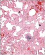 A 65 year old woman with a long history of smoking was found dead at home.An autopsy was requested by the family.They reported that she had recently been experiencing increasing breathlessness.A representative section from her lung is shown in the accompanying photomicrograph.Which one of the following is the best diagnosis?   A) Adenocarcinoma of the lung B) Pulmonary oedema C) Pulmonary embolism D) Pulmonary fibrosis E) Pulmonary infarct