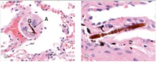 At autopsy of a 69 year old man,the lungs had the appearance shown in the accompanying photomicrographs.Which one of the following is the best diagnosis?   A) Adenocarcinoma B) Asbestosis C) Chronic bronchitis D) Emphysema E) Silicosis