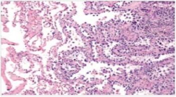 A 53 year old woman with a 40 pack year smoking history consulted her physician for a chronic cough.A chest x-ray disclosed an infiltrate in the right middle lobe.She was treated with two courses of antibiotics,but six weeks later,the infiltrate had not improved.A bronchoscopic biopsy was performed,a representative section of which is shown in the accompanying photomicrograph.Which one of the following is the best diagnosis?   A) Adenocarcinoma B) Bronchioloalveolar carcinoma C) Carcinoid tumour D) Large cell undifferentiated carcinoma E) Small cell carcinoma  F) Squamous cell carcinoma