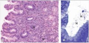 A 26 year old medical student reported epigastric pain and discomfort,often around exam time.Upper GI endoscopy was performed,which reveal oedematous,reddish gastric mucosa.A biopsy was done,a representative section of which is shown in the accompanying photomicrograph.The right panel shows a Cresyl violet special stain.Which one of the following is the best diagnosis?   A) Gastric adenocarcinoma B) Giardia lamblia C) Helicobacter pylori gastritis D) Peptic ulcer E) Psychosomatic  tummy ache 