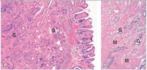 A 48 year old Japanese man who had recently immigrated to the United States was seen by his local physician for fatigue,weight loss,and  feeling full all the time .Endoscopy revealed a polypoid tumour mass with  heaped up  edges.A biopsy was performed,and a representative section is shown in the accompanying photomicrograph.Which one of the following is the best diagnosis?   A) Gastric adenocarcinoma B) Giardia lamblia C) Helicobacter pylori gastritis D) Peptic ulcer E) Signet ring carcinoma