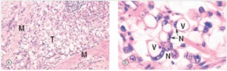 A 48 year old Japanese man who had recently immigrated to the United States was seen by his local physician for fatigue,weight loss,and  feeling full all the time .Endoscopy revealed an absence of rugal folds,and the stomach was difficult to distend with air,so-called  leather bottle stomach .A biopsy was performed,and a representative section is shown in the accompanying photomicrograph.Which one of the following is the best diagnosis?   A) Amoebiasis B) Gastric carcinoma C) Granulomatous inflammation D) Peptic ulcer E) Signet ring cell gastric carcinoma,diffuse type