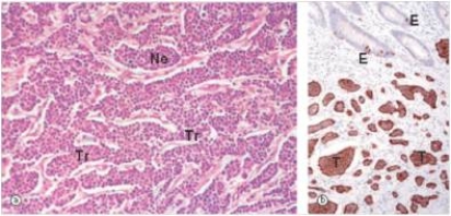 A 38 year old male consulted his local physician because he was experiencing strange episodes of skin flushing and sweating.The physician suspected a GI tumour,and ordered a CT scan,which disclosed a mass in the duodenum,and possible metastatic disease in the liver.The duodenal mass was biopsied,and is shown in the accompanying high power photomicrograph.An immunohistochemistry stain for chromogranin is shown on the right.Which one of the following is the best diagnosis?   A) Adenocarcinoma B) Carcinoid tumour C) Small cell carcinoma D) Pancreatic carcinoma E) Transitional cell carcinoma