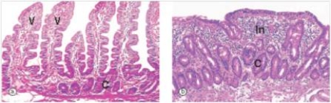 A 24 year old nursing student was having difficulty keeping up in class because of extreme fatigue.She sought help from the Students' Health Service.A full blood count (FBC) showed anaemia with increased RBC (red blood cell) size (macrocytic anaemia) .An upper GI endoscopy was performed,and biopsies taken.A representative section of the biopsy is shown in the accompanying photomicrograph,with normal small bowel shown on the left for comparison (villi are identified as  V ) .Which one of the following is the best diagnosis?   A) Adenocarcinoma B) Coeliac disease C) Crohn's disease D) Iron deficiency anemia E) Ulcerative colitis