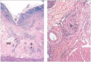 A 25 year old woman woke one morning feeling something wet and warm on her abdomen.When she pulled back the covers,she discovered it was liquid faeces,leaking from a fistulous opening on her abdominal wall,which was soon discovered to have originated in her ileum.She recounted that she had been experiencing diarrhoea for several weeks prior to this event,but had not sought medical attention.At the hospital,a section of small bowel was resected,and the fistula repaired.A representative section of the surgical specimen is shown in the accompanying photomicrograph,with a high power view on the right.Which one of the following is the best diagnosis?   A) Adenocarcinoma B) Crohn's disease C) Peptic ulcer D) Tuberculosis E) Ulcerative colitis