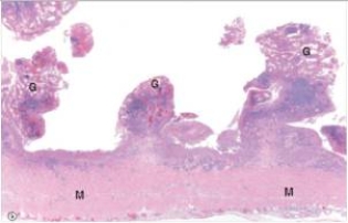 A 35 year old mechanic was experiencing excruciating bouts of bloody diarrhoea.He consulted his local physician,who recommended partial colectomy in order to control the bleeding.A representative section of the specimen is shown in the accompanying low power photomicrograph.Which one of the following is the most likely diagnosis?   A) Adenocarcinoma B) Crohn's disease C) Giardia lamblia D) Peptic ulcer disease E) Ulcerative colitis