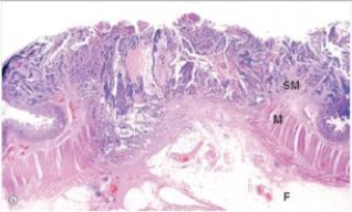 A 48 year old man became alarmed when he noted some bright red blood in his stool.He consulted a local physician,who palpated an indurated area (firm to touch) in the patient's rectum.Surgery was performed,and a representative section of the surgical specimen is show on low power in the accompanying photomicrograph.Which one of the following is the best diagnosis?   A) Adenomatous polyp B) Invasive adenocarcinoma C) Tubulovillous adenoma D) Ulcerative colitis E) Villous adenoma