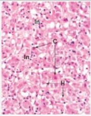 A 22 year old woman returned to the United States from a trip to Mexico.She suddenly became ill,with nausea and vomiting.She underwent a needle biopsy of the liver.Later,serology was found to be positive for hepatitis A virus.A representative section of her liver biopsy is shown in the accompanying photomicrograph.Which one of the following interpretations of the eosinophilic bodies denoted by the arrows marked  C  is most likely CORRECT?   A) Acute inflammatory cells B) Apoptotic bodies C) Bile ducts D) Chronic inflammatory cells E) Mallory's ( alcoholic ) hyaline  F) Viral inclusion bodies