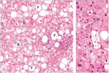 A 50 year old man was brought to the Emergency Department in a stupor by police.A history was unobtainable.An initial workup disclosed jaundice,elevated liver function tests,and a blood alcohol of 300 mg/dL (the legal limit is 80 mg/dL) .In order to ascertain the extent of his liver problem,a needle biopsy of the liver was performed.A representative section of the biopsy is shown in the accompanying photomicrograph.Which one of the following is the most likely composition of the eosinophilic cytoplasmic substance labelled  H  in the high power view of the biopsy shown on the right?   A) Collagen B) Cytokeratin C) Fibrin D) Hyaline E) Vimentin