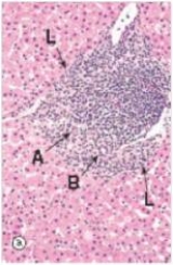A 24 year old man returned from his trip to China only to find himself feeling fatigued,with night sweats.He had an acute bout of hepatitis B in China,but thought he had recovered.A liver biopsy was performed.A representative section is shown in the accompanying photomicrograph.Which one of the following is the best diagnosis?   A) Alcoholic hepatitis B) Chronic hepatitis,low grade C) Cirrhosis D) Lobular hepatitis E) Normal liver histology
