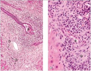 A 47 year old woman presented to her local physician with complaints of nausea and fatigue.She appeared somewhat jaundiced,which was confirmed by serum tests,which showed elevated liver function tests and increased indirect bilirubin.A liver biopsy was performed.A representative section is shown in low and high power in the accompanying photomicrograph.Which one of the following is the best diagnosis?   A) Alcoholic hepatitis B) Ascending cholangitis C) Cirrhosis D) Chronic hepatitis E) Primary biliary cirrhosis