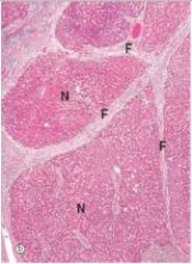A 54 year old homeless male was brought to the Emergency Department vomiting blood.After he was stabilised,a physical exam revealed a hard,nodular liver.A biopsy was later performed,a representative section of which is shown in the accompanying photomicrograph.Which one of the following is the best diagnosis?   A) Acute hepatitis B) Cirrhosis C) Haemochromatosis D) Hepatocellular carcinoma E) Metastatic carcinoma