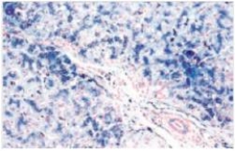A 39 year old male was seen by his local physician for fatigue.Previously,the man had engaged in numerous sports activities,and appeared fit and well-tanned.Routine labs revealed an elevated blood sugar and an elevated liver function test.A liver biopsy was obtained,and a representative section (Perls' stain) is shown in the accompanying photomicrograph.Which one of the following is the best diagnosis?   A) Acute hepatitis B) Cirrhosis C) Haemochromatosis D) Hepatocellular carcinoma E) Metastatic carcinoma