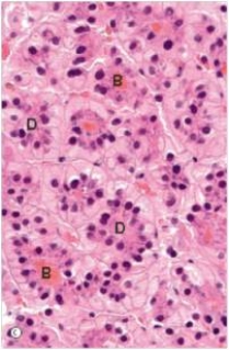 A 54 year old man with alcoholic cirrhosis was seen by a local physician for steadily worsening encephalopathy and ascites.A CT scan disclosed a distinct mass within his scarred liver.A needle biopsy was obtained,a representative section of which is shown in the accompanying photomicrograph.Which one of the following is the best diagnosis?   A) Alcoholic hepatitis B) Hepatocellular carcinoma C) Metastatic carcinoma D) Normal liver histology E) Primary biliary cirrhosis