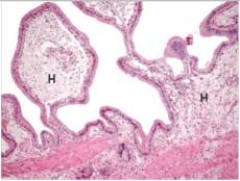 An obese,40 year old mother of four complained of nausea,diarrhoea,and foul-smelling stools.Physical examination revealed tenderness in the right upper quadrant.A laparoscopic cholecystectomy was then scheduled and later performed.The gross specimen showed flecks of yellow on the red,inflamed mucosa of the gall bladder.A representative section is shown in the accompanying photomicrograph.Which one of the following is the best diagnosis?   A) Carcinoma of the gall bladder B) Gallstones (cholelithiasis)  C) Granulomatous inflammation of the gall bladder D) Strawberry gall bladder E) Tuberculosis of the gall bladder