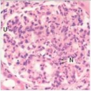 An 8 year old child was brought to his family physician because of fever,lethargy,and sudden weight gain.He had previously been well,except for a recent bout with  strep throat .Upon physical examination,severe peripheral oedema (grade 3+) was noted.Urinalysis disclosed increased amounts of protein and RBCs.A renal biopsy was performed,a representative section of which is shown in the accompanying photomicrograph.Which one of the following is the best diagnosis?   A) Acute proliferative glomerulonephritis B) Diabetic glomerulosclerosis C) Focal segmental glomerulonephritis D) Membranous nephropathy E) Mesangiocapillary (Membranoproliferative) glomerulonephritis  F) Minimal change disease G) Normal glomerulus H) Rapidly progressive glomerulonephritis (RPGN) 