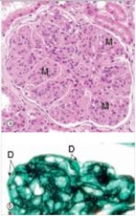 A 43 year old man with chronic hepatitis B was seen by a nephrologist,after his primary care physician initially diagnosed nephrotic syndrome.A renal biopsy way performed,a representative section of which is shown in the accompanying photomicrograph,including a high power silver stain of the glomerulus (bottom) .Which one of the following is the best diagnosis?   A) Acute proliferative glomerulonephritis B) Diabetic glomerulosclerosis C) Focal segmental glomerulonephritis D) Membranous nephropathy E) Mesangiocapillary (Membranoproliferative) glomerulonephritis  F) Minimal change disease G) Normal glomerulus H) Rapidly progressive glomerulonephritis (RPGN) 